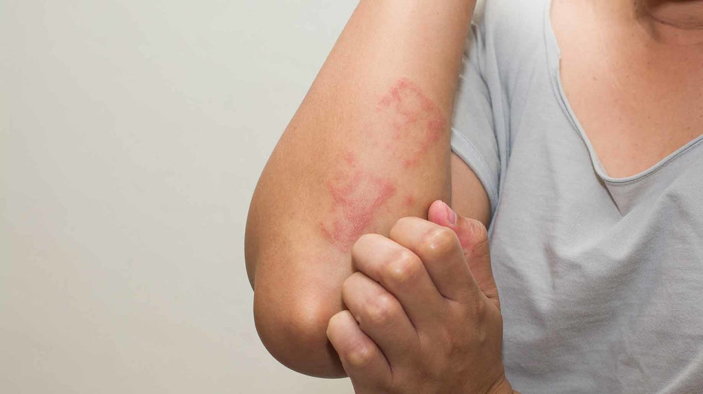 What To Do When Eczema Is Unbearable? - Sanbe Beauty, LLC