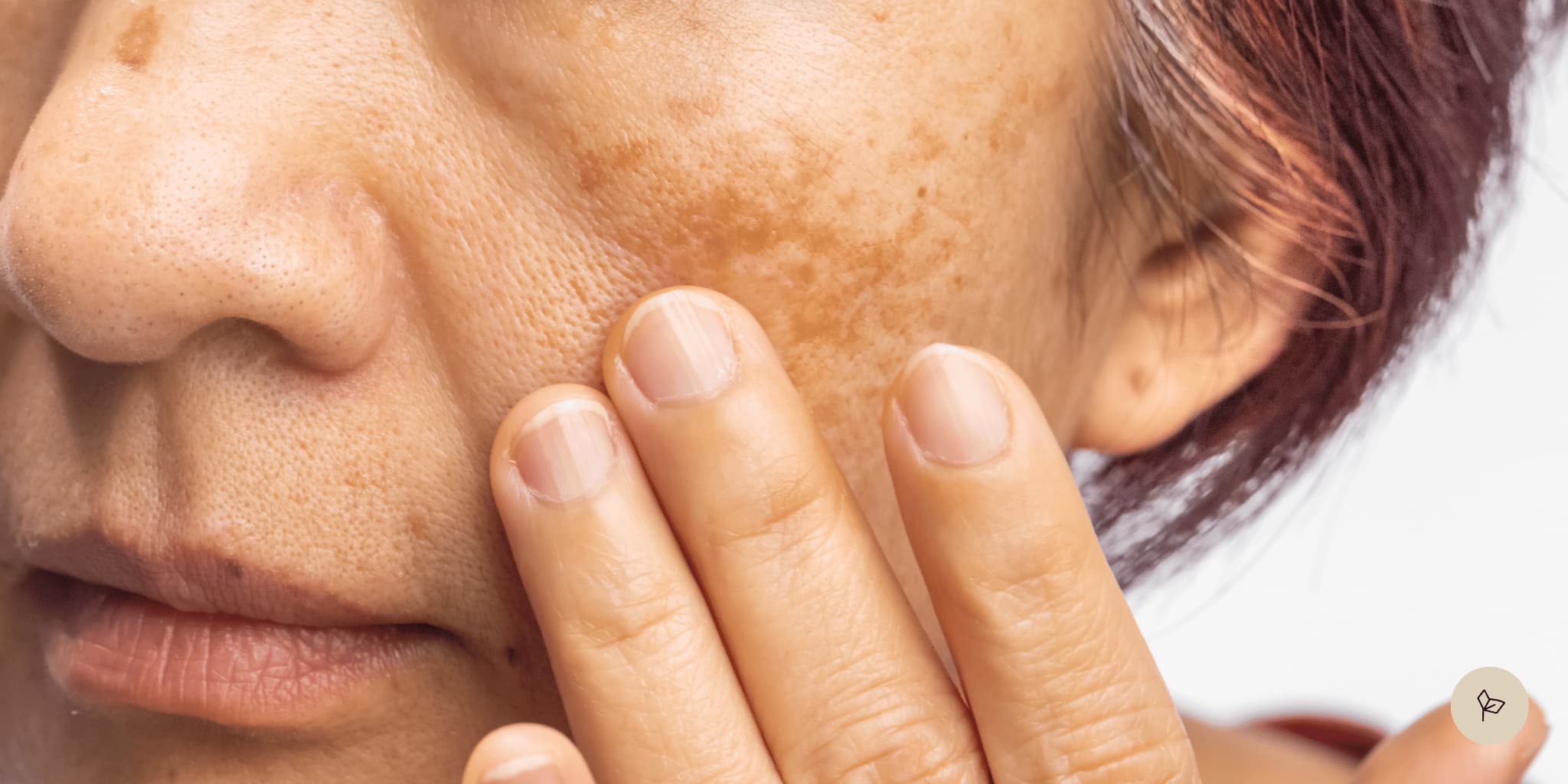 Melasma vs. hyperpigmentation