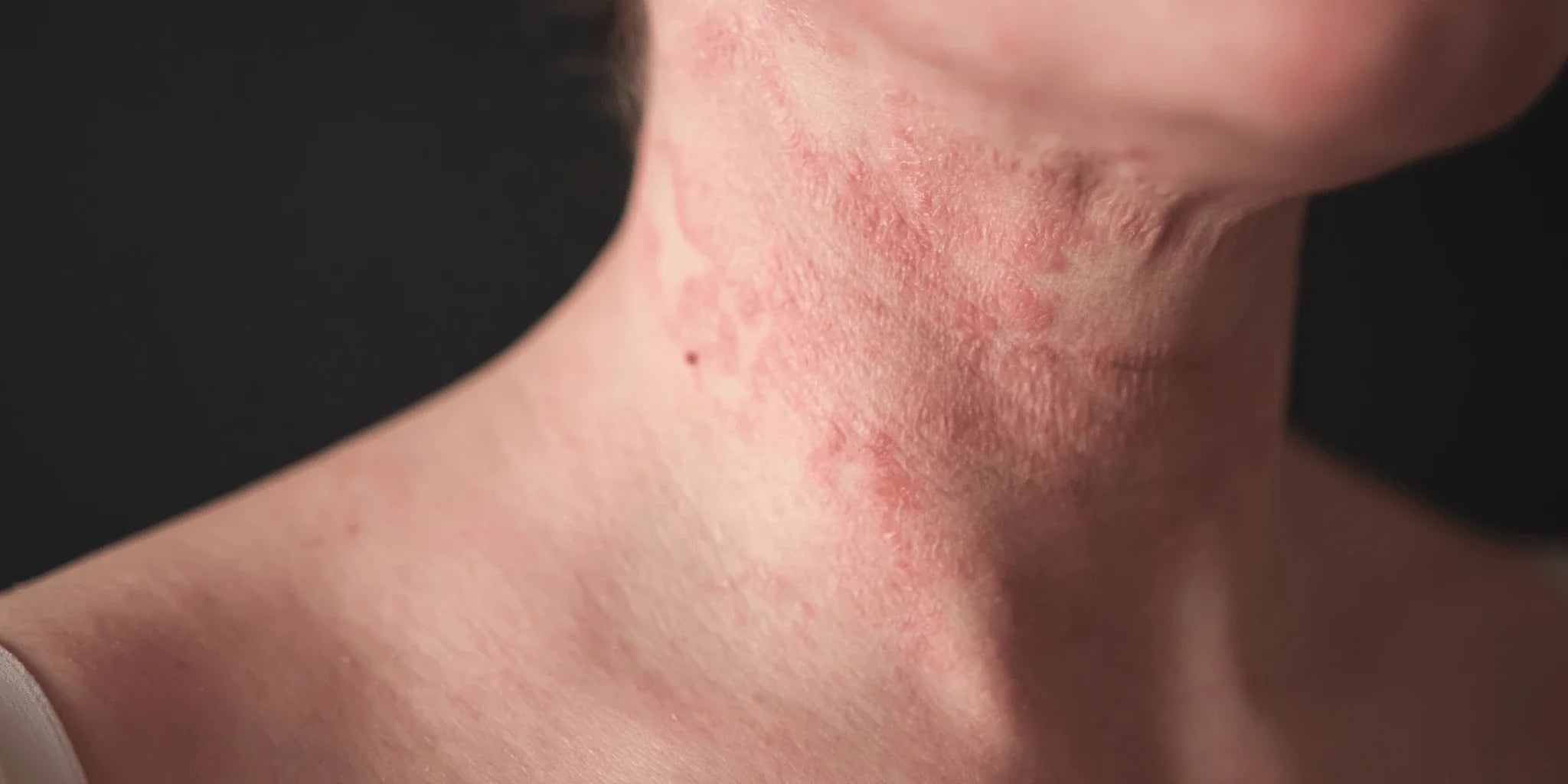 Women with atopic dermatitis on the neck.