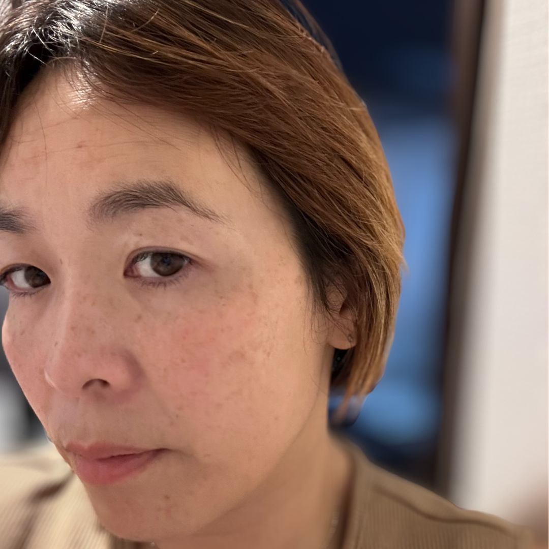 Mai - Sun Damage Oily Skin After