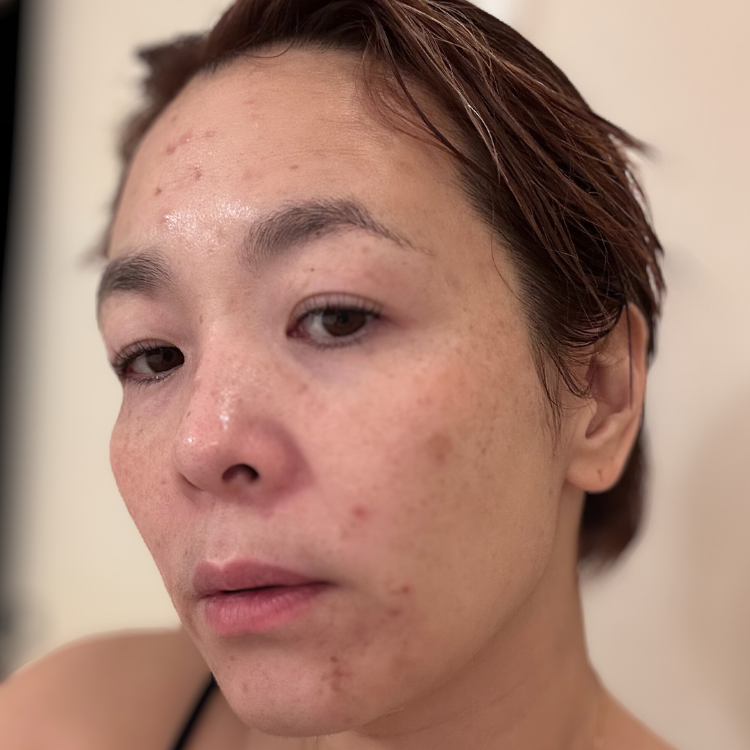 Mai - Sun Damaged Oily Skin